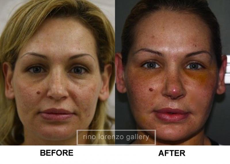 for facial injection Fat lines deep