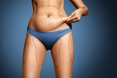 liposuction in manila