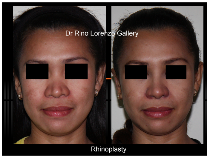 rhinoplasty philippines