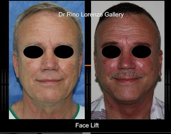 face lift surgery