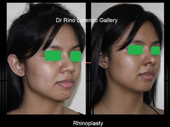 before and after rhinoplasty